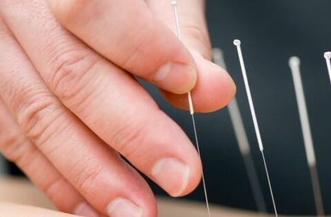 DRY NEEDLING